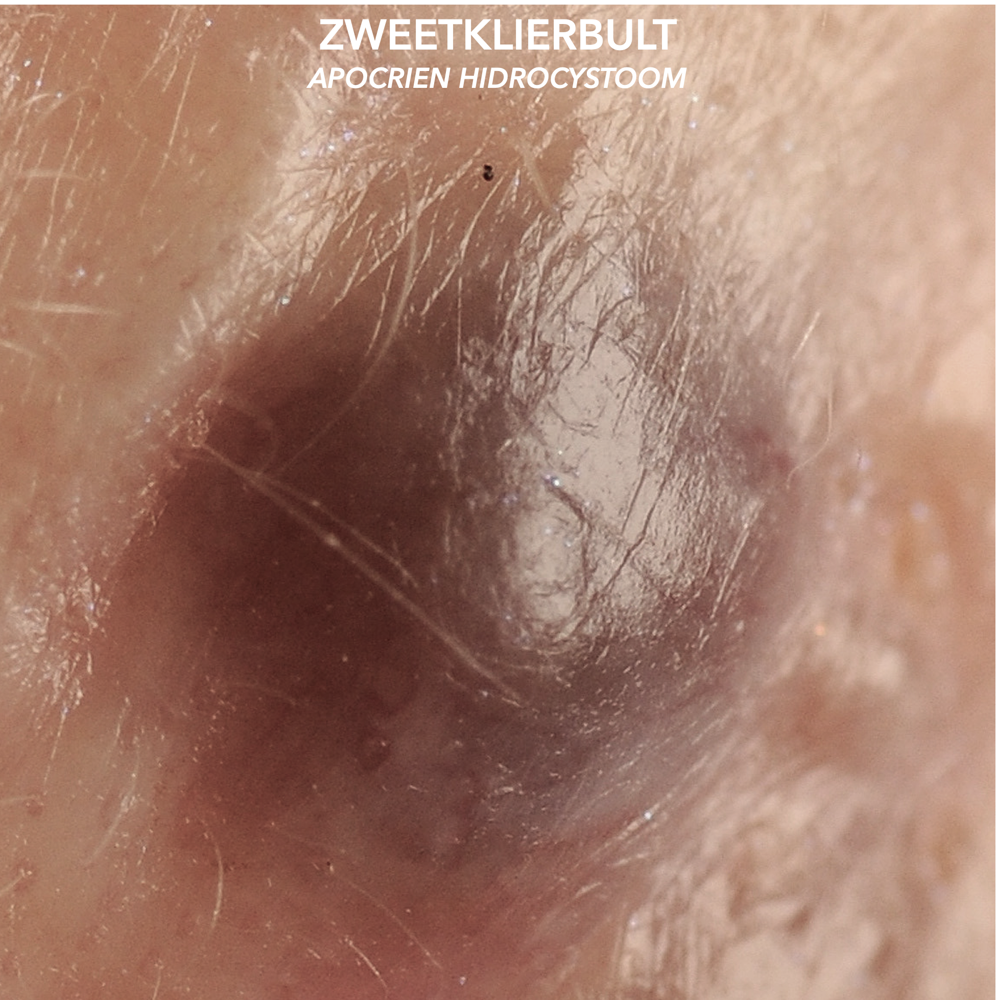 Zweetklierbultje onder het oog van het type apocrien hidrocystoom