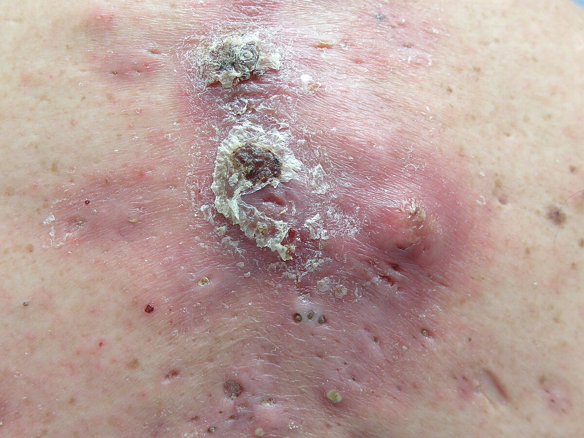 Acne conglobata
