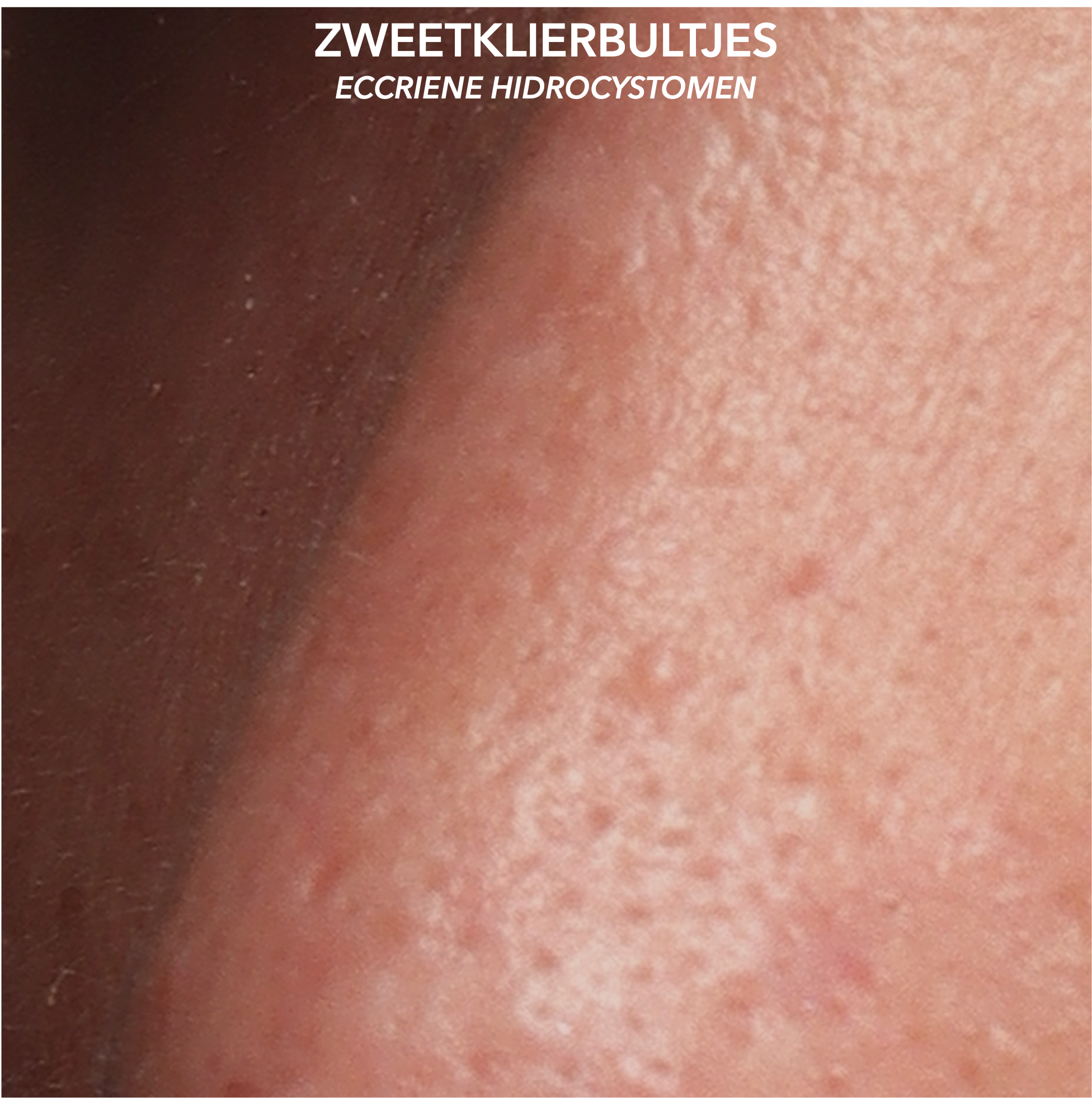 Zweetklierbultjes op de neus na behandeling met botuline toxine en cryotherapie - close-up