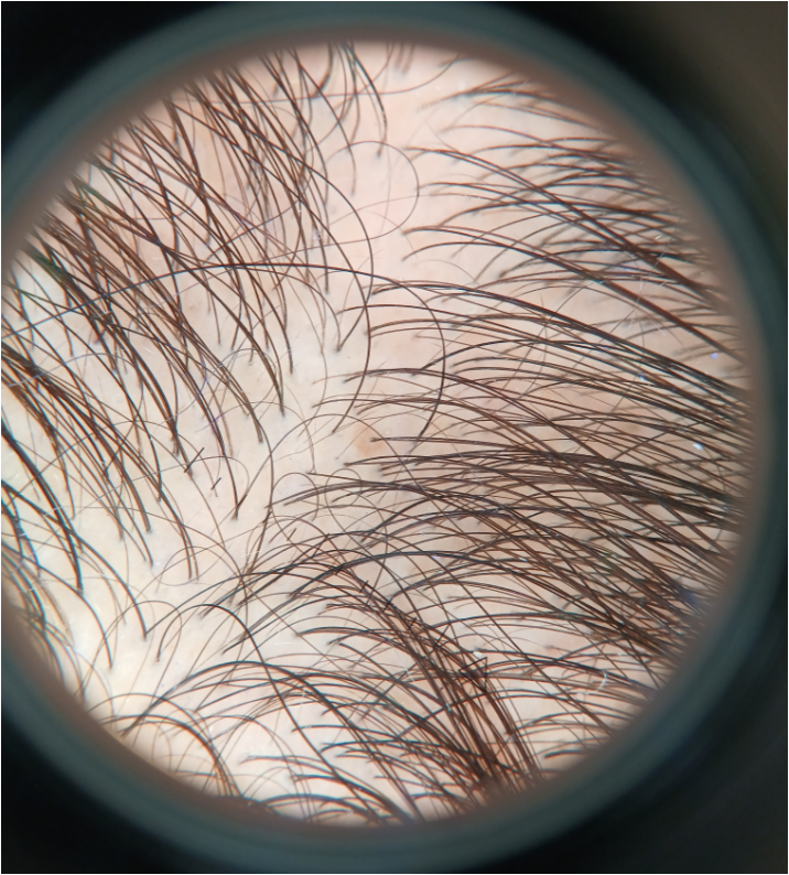 Lonely hairs