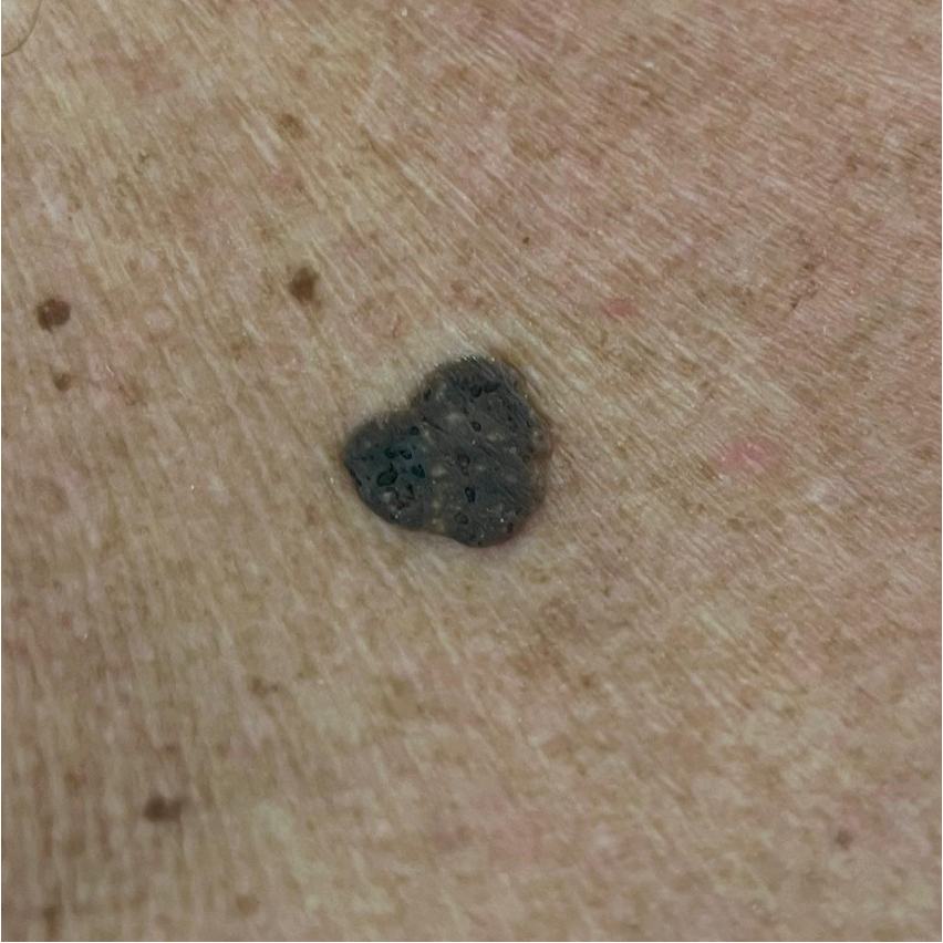 Verruca seborrhoica